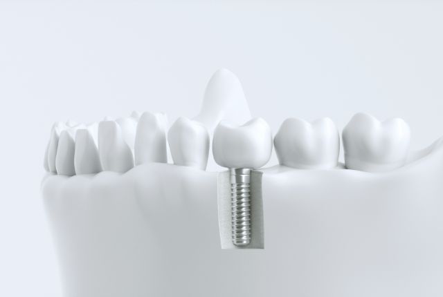 インプラントのイメージ画像