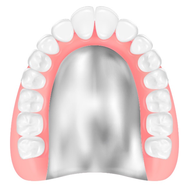金属床義歯（きんぞくしょうぎし）