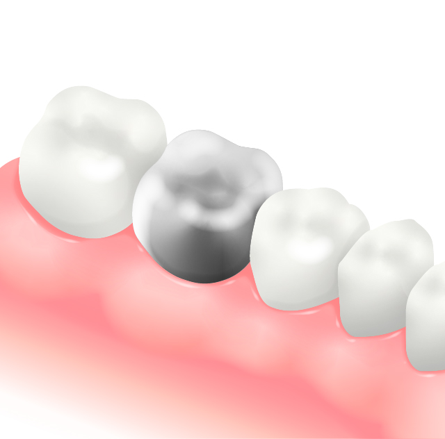 メタルクラウン（銀歯）