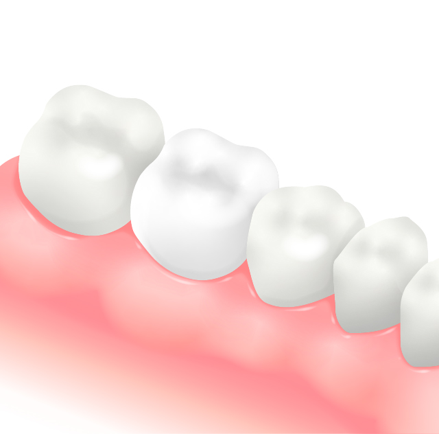 フルジルコニア