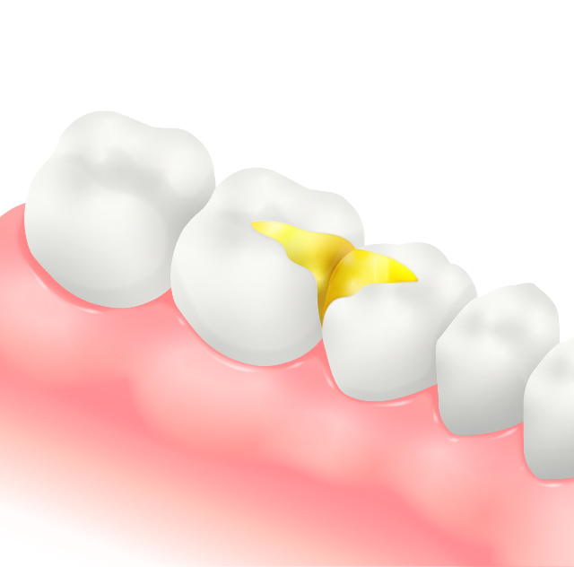 ゴールドインレー（PGA）