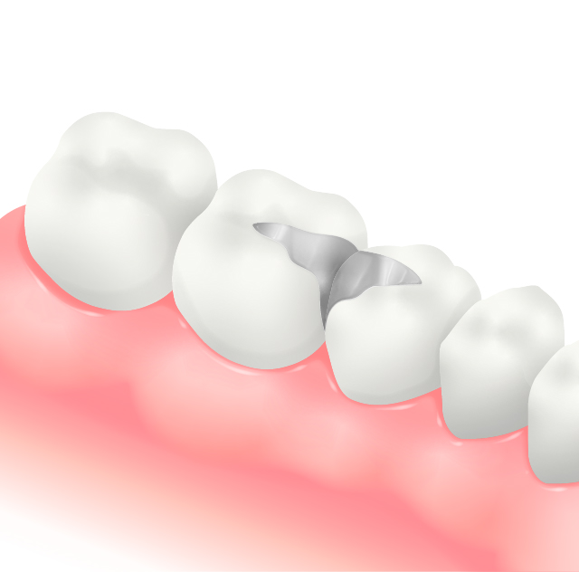 メタルインレー（銀歯）