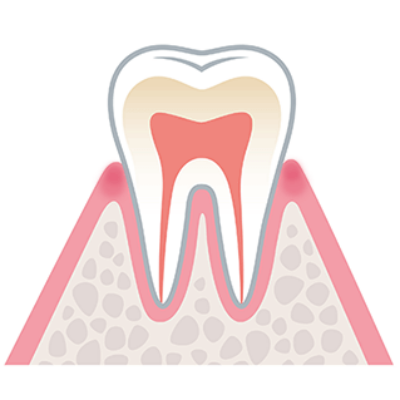 歯肉炎（しにくえん）